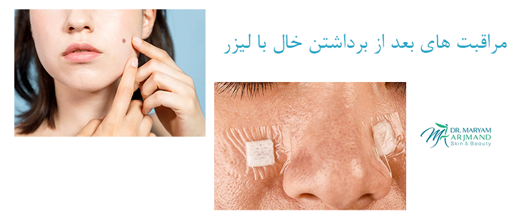 مراقبت های بعد از برداشتن خال با لیزر