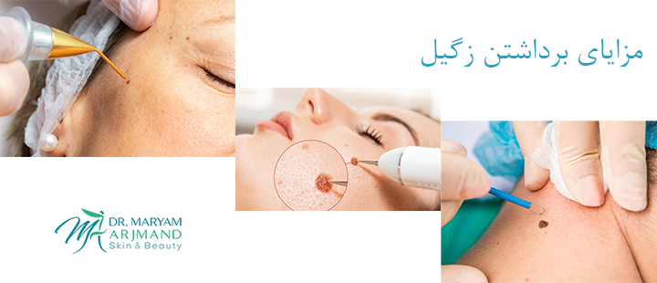 مزایای برداشتن زگیل