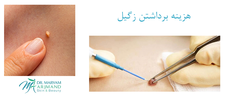 هزینه برداشتن زگیل