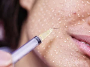 هزینه مزوتراپی صورت