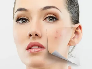 جوش زدن بعد از لیزر موهای زائد