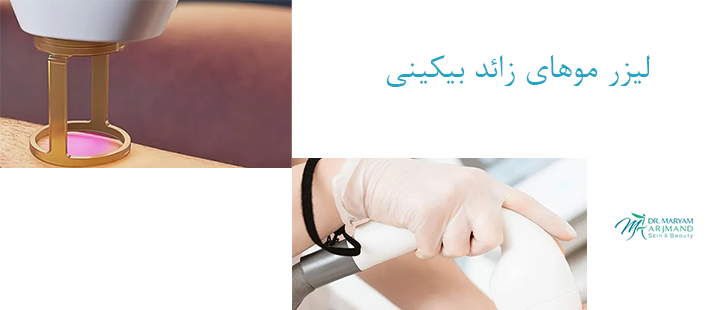 درباره لیزر موهای بیکینی