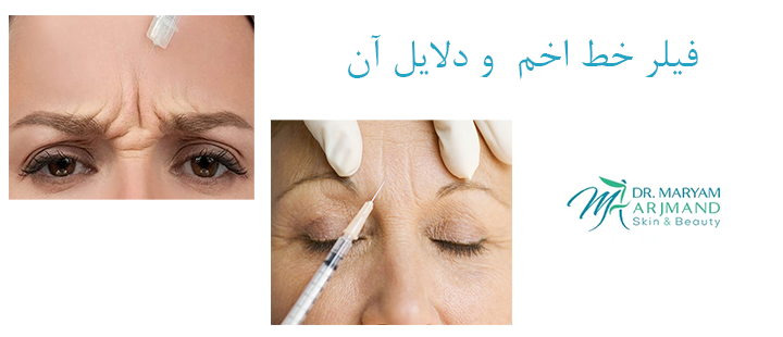 فیلر خط اخم و دلایل آن 