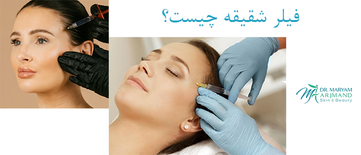 فیلر شقیقه چیست؟