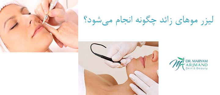 لیزر موهای زائد چگونه انجام می‌شود؟