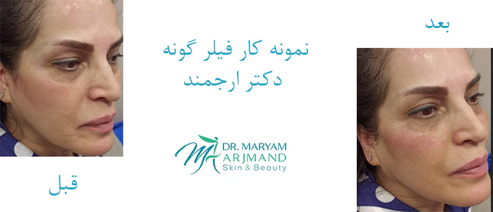 نمونه کار فیلر گونه دکتر ارجمند