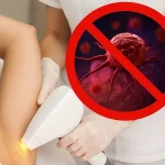 لیزر موهای زائد و سرطان