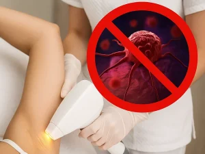 لیزر موهای زائد و سرطان