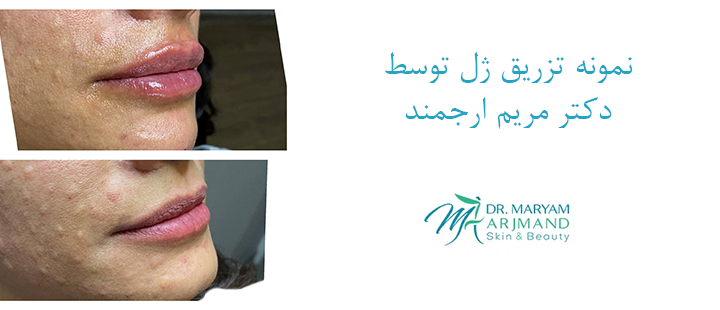 تزریق ژل توسط دکتر ارجمند